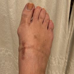 Michael L. Goddard, D.P.M - 1 year post lapiplasty. The constant pain and disfigurement of the scar tissue is far worse than the bunion pain ever was.