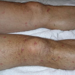 Patient suffered almost 2 years with non-explainable skin rash. He went through 11 different kinds of antibiotics but no success