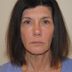K Cary Canoun, M.D., F.A.C.S - Facelift before