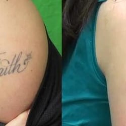 Paradise Med Spas of Texas - Laser Tattoo Removal