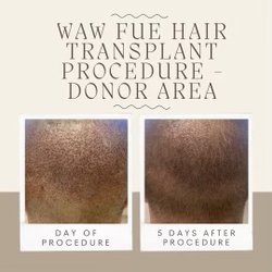 Hair 4 Life Medical - WAW System FUE + Post-op protocol = quick healing and minimal scarring