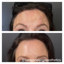 Luxe Concierge Aesthetics  - Jeuveau Results after 2 weeks!