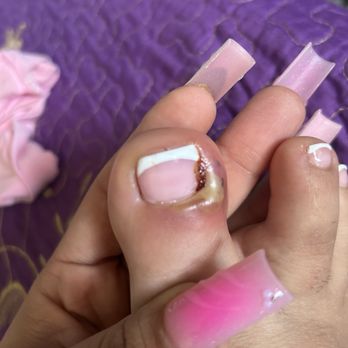 Dila Nails and Spa - This happened right after getting a pedicure!! This place needs to get sued! I'm stuck with a hospital bill! Dila spa is the worst! - Waxing Near Me - Stockton, California Dila Nails and Spa - This happened right after getting a pedicure!! This place needs to get sued! I'm stuck with a hospital bill! Dila spa is the worst! - Waxing Near Me - Stockton, California