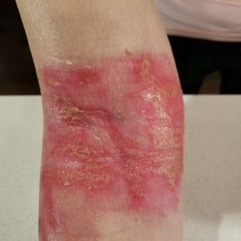 Robert F Gray, MD, FACS - This was multiple weeks after the laser treatment by Robert F. Gray. - Cosmetic Surgeons Near Me - Pleasanton, California Robert F Gray, MD, FACS - This was multiple weeks after the laser treatment by Robert F. Gray. - Cosmetic Surgeons Near Me - Pleasanton, California