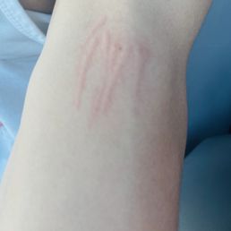 Scratches on arm from massage Scratches on arm from massage