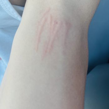 Tony Nails & Spa - Scratches on arm from massage - Nail Salons Near Me - Brentwood, California Tony Nails & Spa - Scratches on arm from massage - Nail Salons Near Me - Brentwood, California