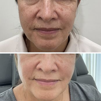 Skintastic Medi Spa - Before and After of the Enlighten Peel - Skin Care Near Me - Riverside, California Skintastic Medi Spa - Before and After of the Enlighten Peel - Skin Care Near Me - Riverside, California