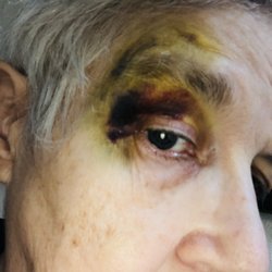 Santa Rosa Medical Center - Bruised face