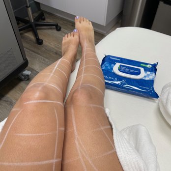LaserAway - Chalk for mapping out laser hair removal and wipes for after service is done. - Medical Spas Near Me - Cerritos, California LaserAway - Chalk for mapping out laser hair removal and wipes for after service is done. - Medical Spas Near Me - Cerritos, California