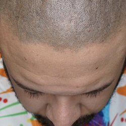 Scalp Society - Rebuilt my hairline to zone 2