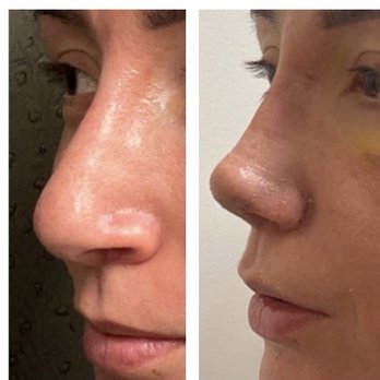 Ronald J Edelson, MD - Before on the left and immediately after cast removal on the right. - Cosmetic Surgeons Near Me - San Diego, California Ronald J Edelson, MD - Before on the left and immediately after cast removal on the right. - Cosmetic Surgeons Near Me - San Diego, California