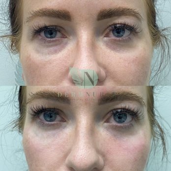 DermNurse Medical Aesthetics - Before and after a tear trough dermal filler injection. See how immediately the under eye area looks brighter and more youthful? - Medical Spas Near Me - Calgary, Alberta DermNurse Medical Aesthetics - Before and after a tear trough dermal filler injection. See how immediately the under eye area looks brighter and more youthful? - Medical Spas Near Me - Calgary, Alberta