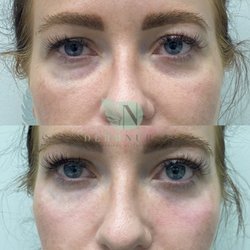 DermNurse Medical Aesthetics - Before and after a tear trough dermal filler injection. See how immediately the under eye area looks brighter and more youthful?