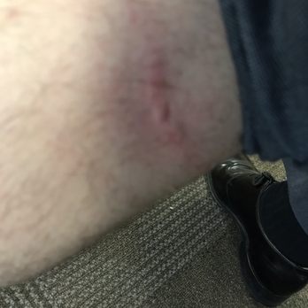 The Normandy Hotel - Bite marks that showed up on my leg after staying there overnight... - Hotels Near Me - Washington, DC, District of Columbia