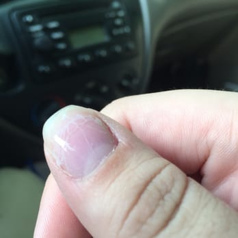 Nail Envy - This thumb was also covered in cracks and lost the whole tip. - Nail Salons Near Me - Saint Louis, Missouri Nail Envy - This thumb was also covered in cracks and lost the whole tip. - Nail Salons Near Me - Saint Louis, Missouri