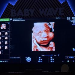 Baby Wave 4D Ultrasound - Our daughter