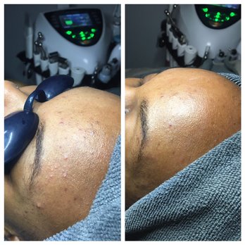 Vian Aesthetics - Before and after ! After only one face treatment - Day Spas Near Me - Chicago, Illinois Vian Aesthetics - Before and after ! After only one face treatment - Day Spas Near Me - Chicago, Illinois