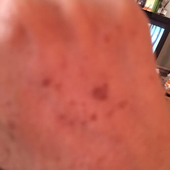 Rinnova Medi Spa - Before and after photos of my hands after one treatment. - Medical Spas Near Me - Brooklyn, New York Rinnova Medi Spa - Before and after photos of my hands after one treatment. - Medical Spas Near Me - Brooklyn, New York