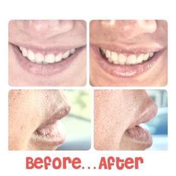 Ko'olau Clinic - LIP FLIP only: Less gumby smile. No lip filler. Bottom R pic was taken immediately after, still swollen. Top R was a day after treatment. - Medical Spas Near Me - Kailua, Hawaii Ko'olau Clinic - LIP FLIP only: Less gumby smile. No lip filler. Bottom R pic was taken immediately after, still swollen. Top R was a day after treatment. - Medical Spas Near Me - Kailua, Hawaii