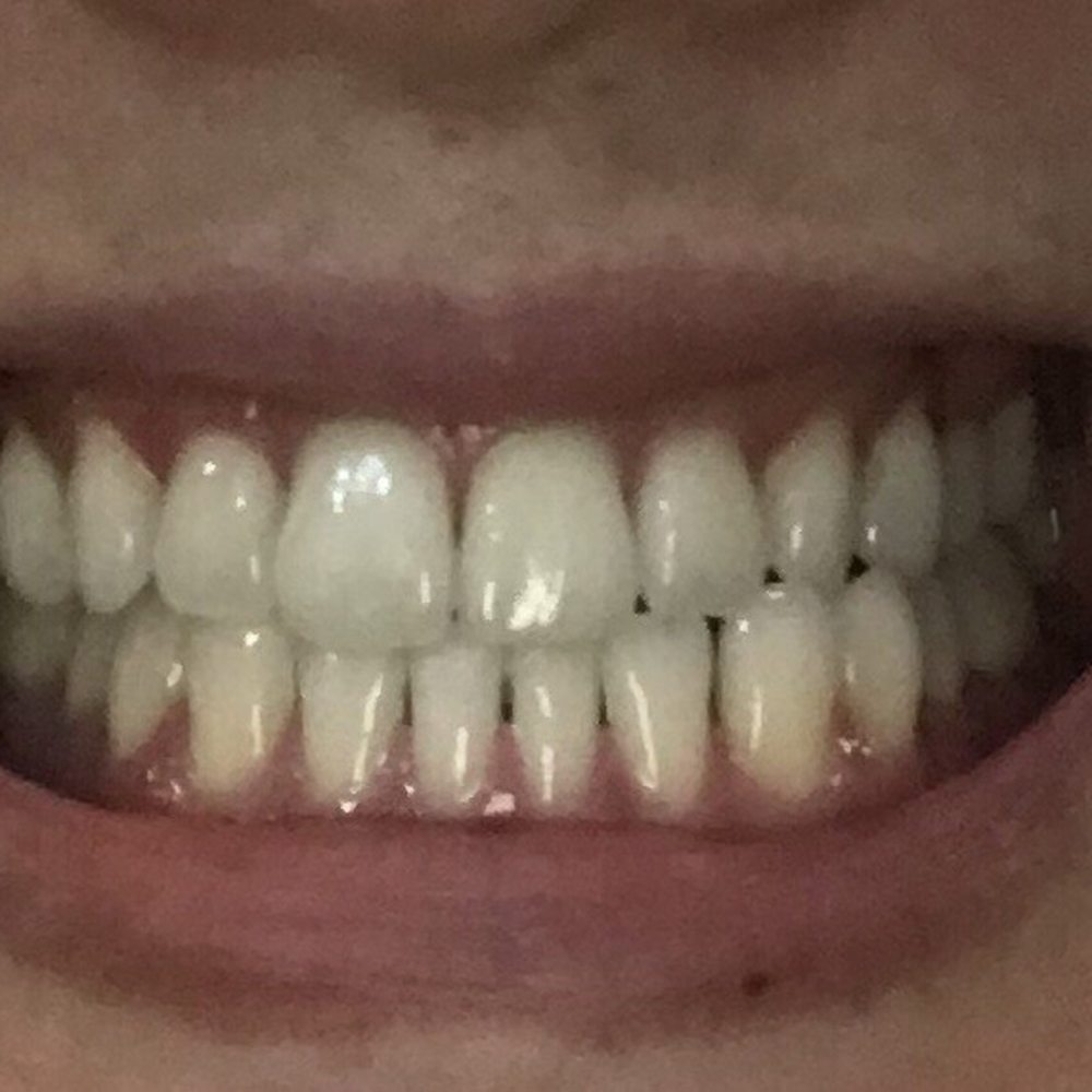e-Dental Center - What my teeth and gums looked like at time of visit. - Cosmetic Dentists Near Me - Los Angeles, California e-Dental Center - What my teeth and gums looked like at time of visit. - Cosmetic Dentists Near Me - Los Angeles, California