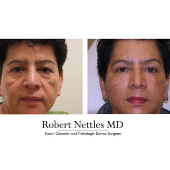 Robert Nettles, MD - Full face-lift with NO SURGERY - Medical Spas Near Me - Santa Monica, California Robert Nettles, MD - Full face-lift with NO SURGERY - Medical Spas Near Me - Santa Monica, California