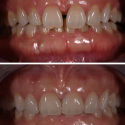 Rong-Jang Wu, DMD - Close the gap with veneer