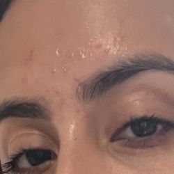 Painful Folliculitis a few days after threading