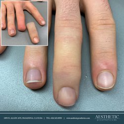 Aesthetic Prosthetics