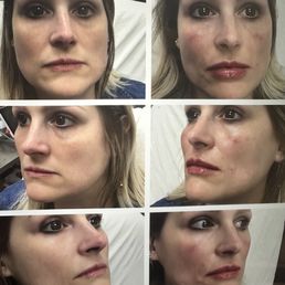 My first filler appointment with Marcel. I did cheeks, lips and nostril folds. Very happy with the results.