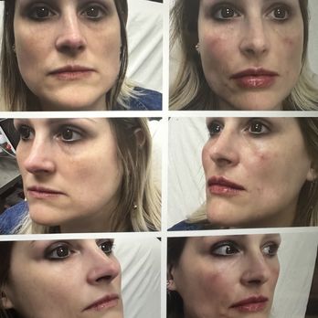 LaserAway - My first filler appointment with Marcel. I did cheeks, lips and nostril folds. Very happy with the results. - Laser Hair Removal Near Me - Valencia, California