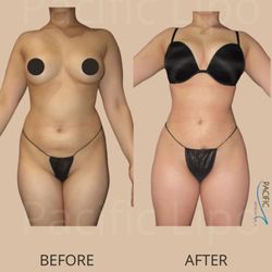 Pacific Lipo - Los Angeles