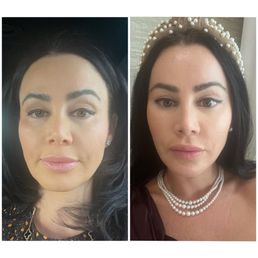 3 weeks post op endoscopic brow & midface lift 3 weeks post op endoscopic brow & midface lift