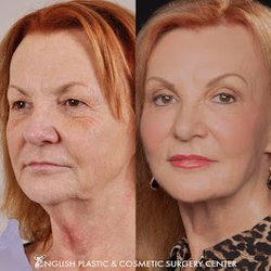 English Plastic and Cosmetic Surgery Center - Before & After Results of English Plastic and Cosmetic Surgery Center | Little Rock, AR