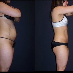 Cupertino Medical Laser Center - Smartlipo for Full abdomen performed by Yung Chen MD