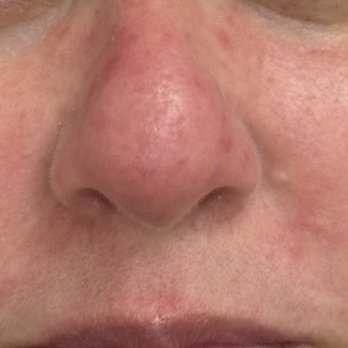The DermBar - After first treatment - Dermatologists Near Me - Ontario, California