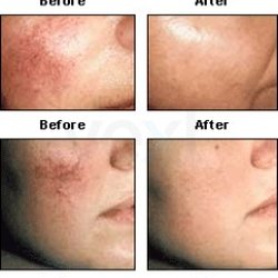 Advanced Dermatology - Facial Telangiectasia/Rosacea treatment with PDL Vbeam Laser