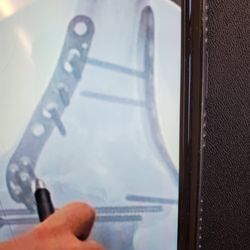 El Cerrito Hand Therapy &  Acupuncture - Complex ELBOW Fracture ,Big Surgery., Lots of hardware . Must have Speicalized OT/ARM/Hand Clinical treatment.