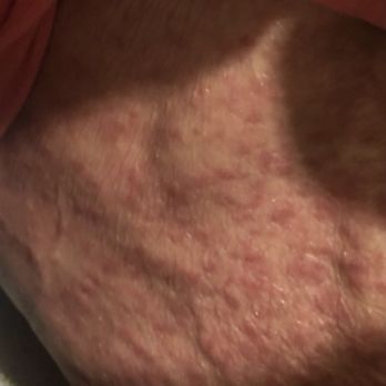 Oak Park Manor - These are bites from the scabies on my moms back and stomach. - Retirement Homes Near Me - Claremont, California Oak Park Manor - These are bites from the scabies on my moms back and stomach. - Retirement Homes Near Me - Claremont, California