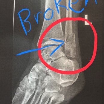 Volcano Hiking Tours - X-ray taken on 04/28/18, 3 weeks after breaking my fibula on the 13 mile Sunset Lava Hike - Tours Near Me - Pahoa, Hawaii Volcano Hiking Tours - X-ray taken on 04/28/18, 3 weeks after breaking my fibula on the 13 mile Sunset Lava Hike - Tours Near Me - Pahoa, Hawaii