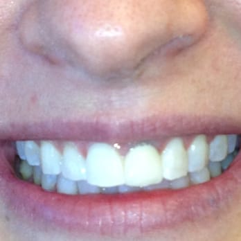 Richard F Creaghe, DDS - JennyB after one hour BriteSmile with Dr. Creagh. Whoohoo - Oral Surgeons Near Me - San Rafael, California