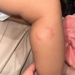 Toddler bite