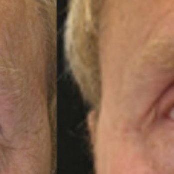 Kristin J Tarbet, MD - I now have to wear eyeglasses again as the sun finds my eyes! - Cosmetic Surgeons Near Me - Bellevue, Washington