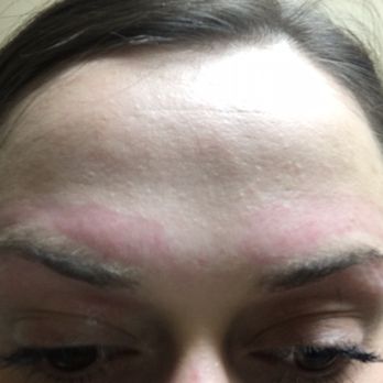Diamond Nail Beauty Salon - Day 1: minutes after, you can see the redness on my forehead, nowhere near eyebrow - Hair Salons Near Me - Hamilton, Ontario Diamond Nail Beauty Salon - Day 1: minutes after, you can see the redness on my forehead, nowhere near eyebrow - Hair Salons Near Me - Hamilton, Ontario