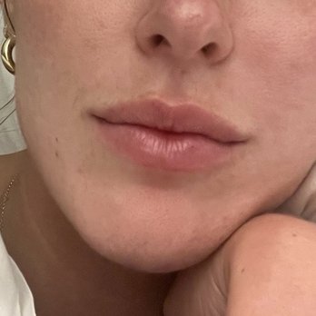 SkinTight Aesthetics - My lips before..... - Skin Care Near Me - Los Angeles, California SkinTight Aesthetics - My lips before..... - Skin Care Near Me - Los Angeles, California