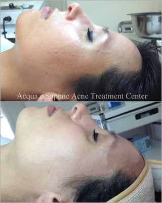AES Acne Clinic by null