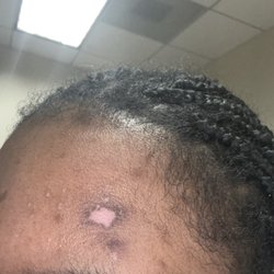 Capital Dermatology of NC - The burn mark that was left from the chemical peel!  Do not get a chemical peel here, pay the extra money and go to a spa.