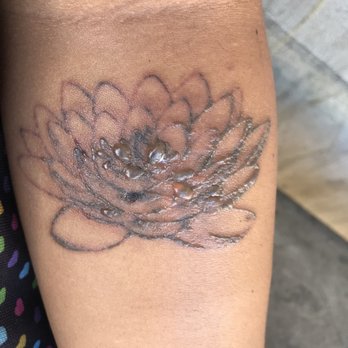 Way Gone Laser Tattoo Removal - 2 days after treatment - Tattoo Removal Near Me - Honolulu, Hawaii Way Gone Laser Tattoo Removal - 2 days after treatment - Tattoo Removal Near Me - Honolulu, Hawaii