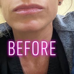 Indulgence Medical Day Spa - Lips before fillers