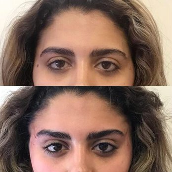 Windward Med Spa - Thread Lift for Brows - Medical Spas Near Me - Alpharetta, Georgia Windward Med Spa - Thread Lift for Brows - Medical Spas Near Me - Alpharetta, Georgia