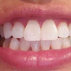 Bella Sorriso - After photo, very happy with the results!!